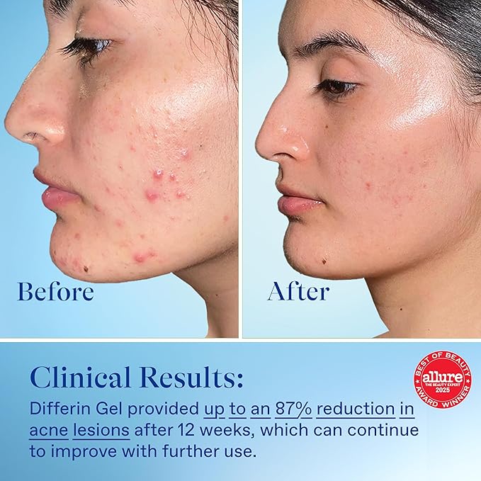 Differin Acne Treatment Gel, 60 Day Supply, Retinoid Treatment for Face with 0.1% Adapalene, Gentle Skin Care for Acne Prone Sensitive Skin, 15g Tube (Pack of 2) (Packaging May Vary)